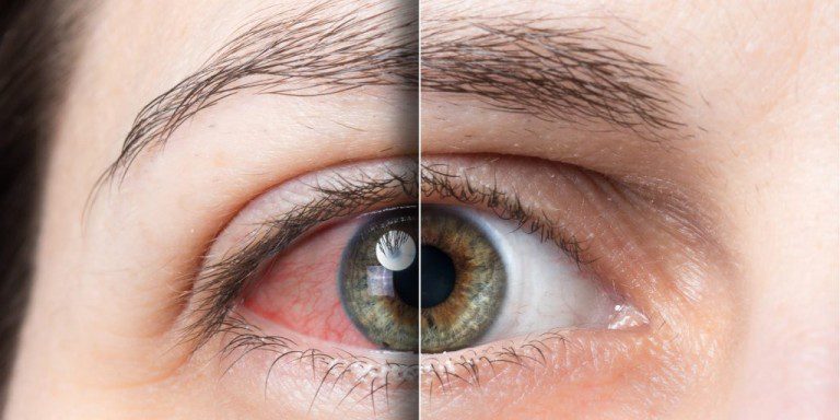 Alcoholic Eyes: Identifying and Treating Alcoholic Vision Loss Alcoholic Eyes: Identifying and Treating Alcoholic Vision Loss