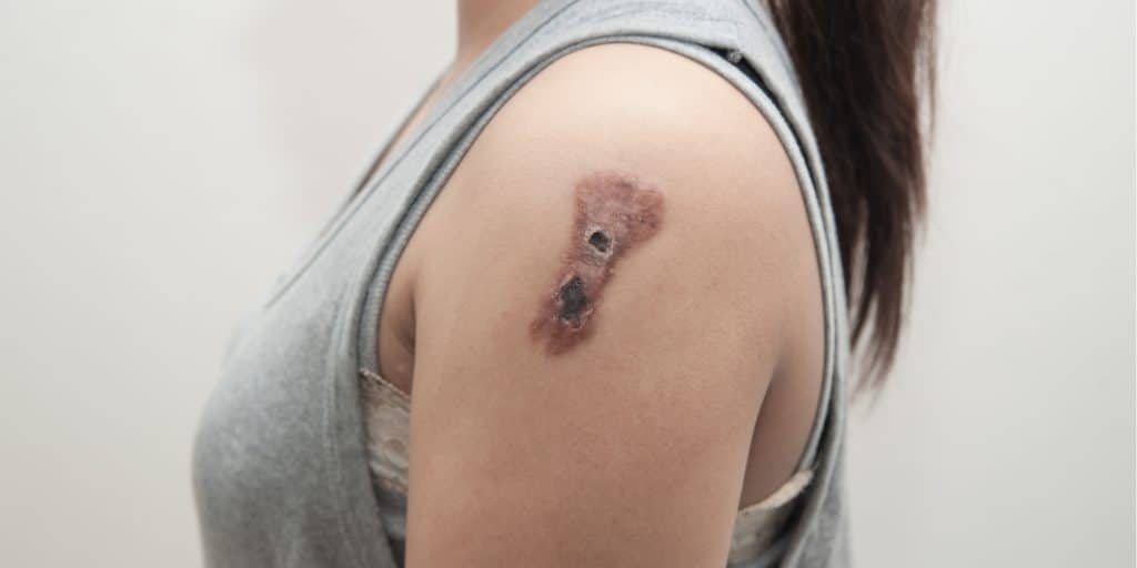 Effects of Alcohol on skin Effects of Alcohol on skin