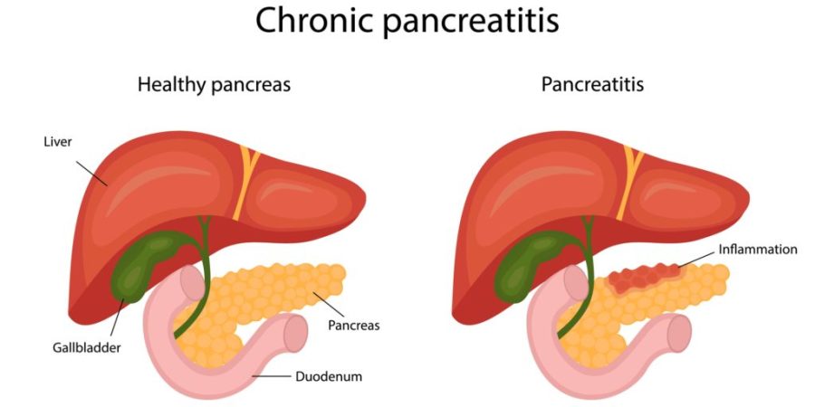 Chronic Pancreatitis